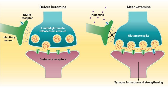 Ketamine Infusion Therapy Miami