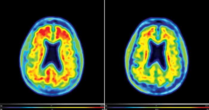 Biogen Buys Into Denali S Parkinson S Disease Drug Candidates