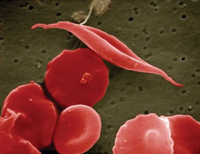 A photo of a sickle cell next to healthy red blood cells. 20200916lnp2-cell.jpg
